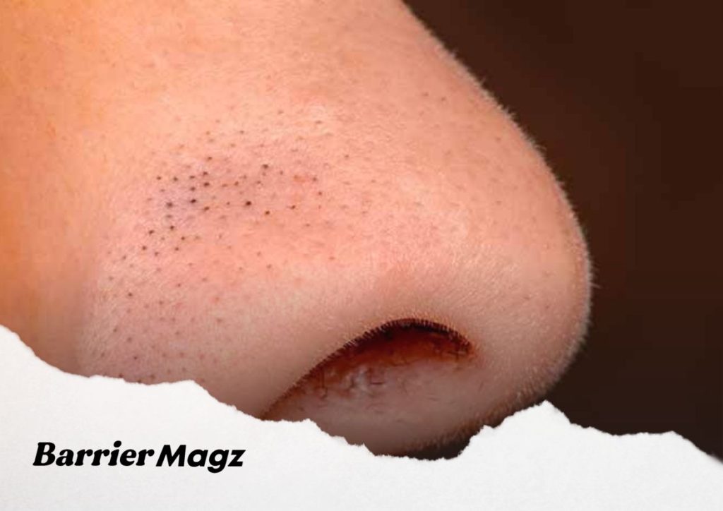Tips Menghilangkan Komedo Hitam dan Putih di Hidung